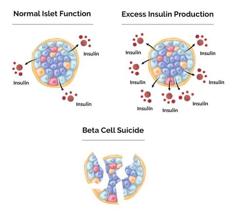 beta cells and diabetes|Beta Cell Dysfunction and Insulin Resistance .
